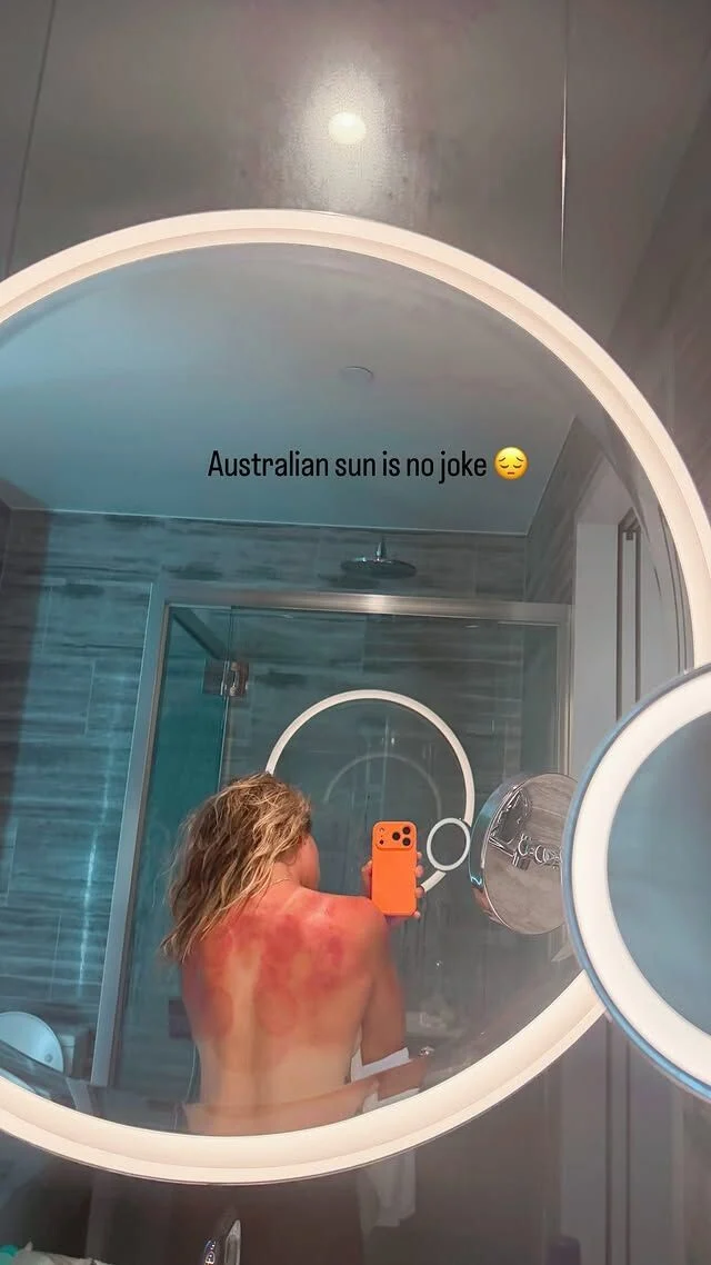 Мексиканска тенисерка изгоре од силното сонце во Австралија