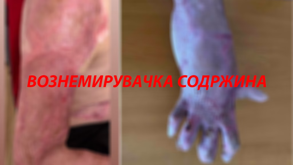 ПОТРЕСНИ ФОТОГРАФИИ 10 МЕСЕЦИ ПО ТРАГЕДИЈАТА ВО „ПУЛС“: Лузните сè уште болат – итно се потребни креми за повредените