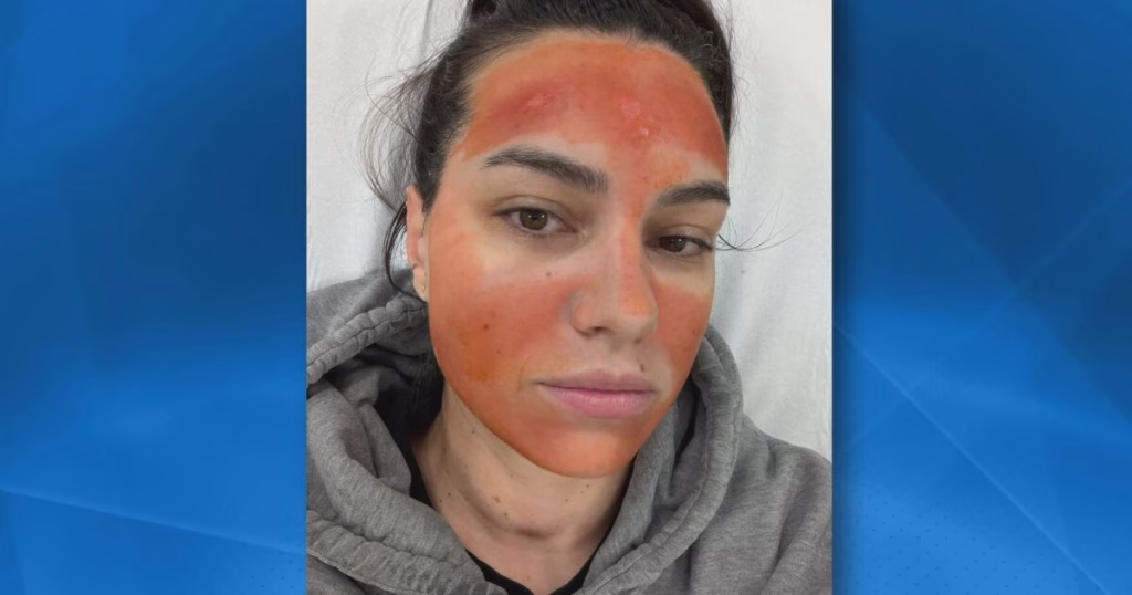 Хорор наместо разубавување: Девојка заврши со изгореници од втор степен по хемиски пилинг – козметичарката работела „на диво“