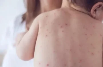 ЕПИДЕМИЈА НА МАЛИ СИПАНИЦИ ВО ЛОНДОН: Се шират предупредувања за итна вакцинација