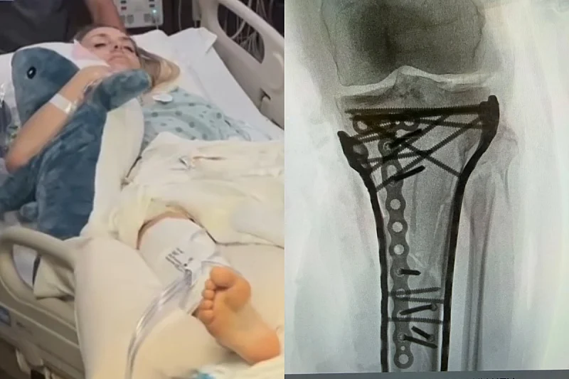 Ете како изгледа коленото на Линдзи Вон по уште една операција (Фото+Видео)